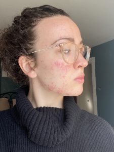 picture of the right side of my face with acne and blemishes